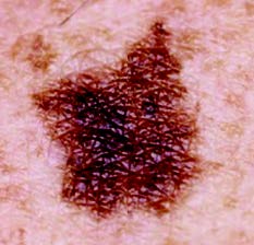 skin-cancer-mole-cancerous