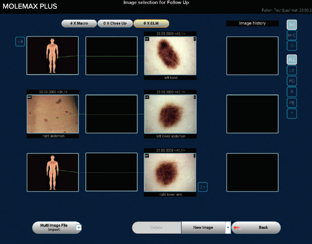 molemax-plus-software-skin-imaging